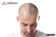 Milano Klinik Saç Ekimi | Şişli | İstanbul